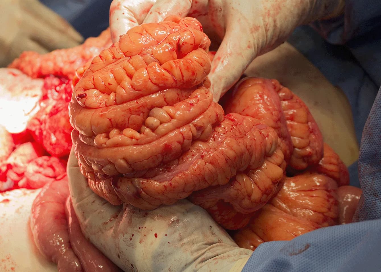 Disease-focused mesentery investigation image